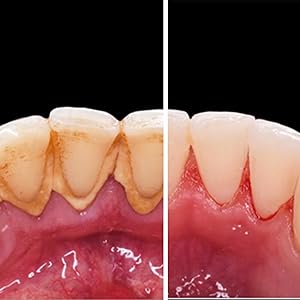 how to remove tartar from teeth
