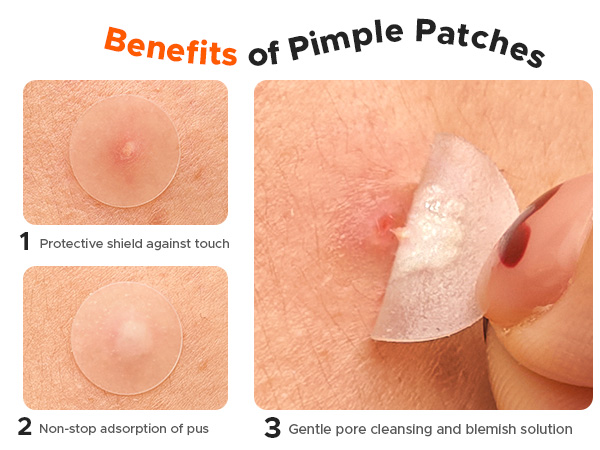 Benefits of Pimple Patches