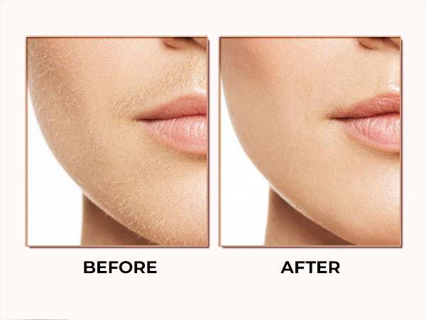 Facial Hair Removal for Women