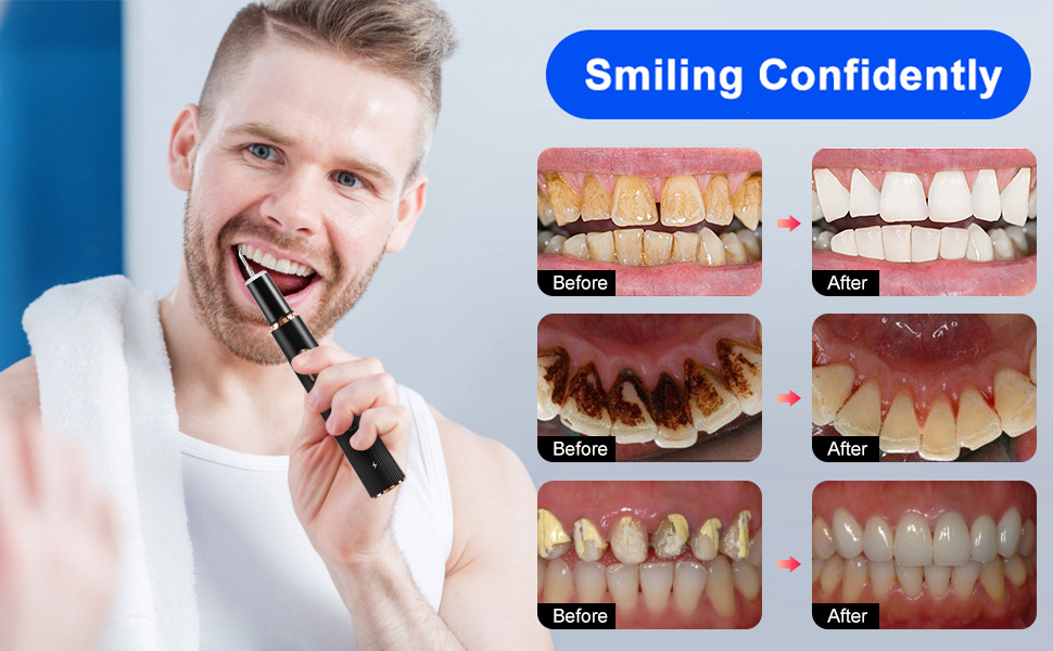 plaque remover for teeth