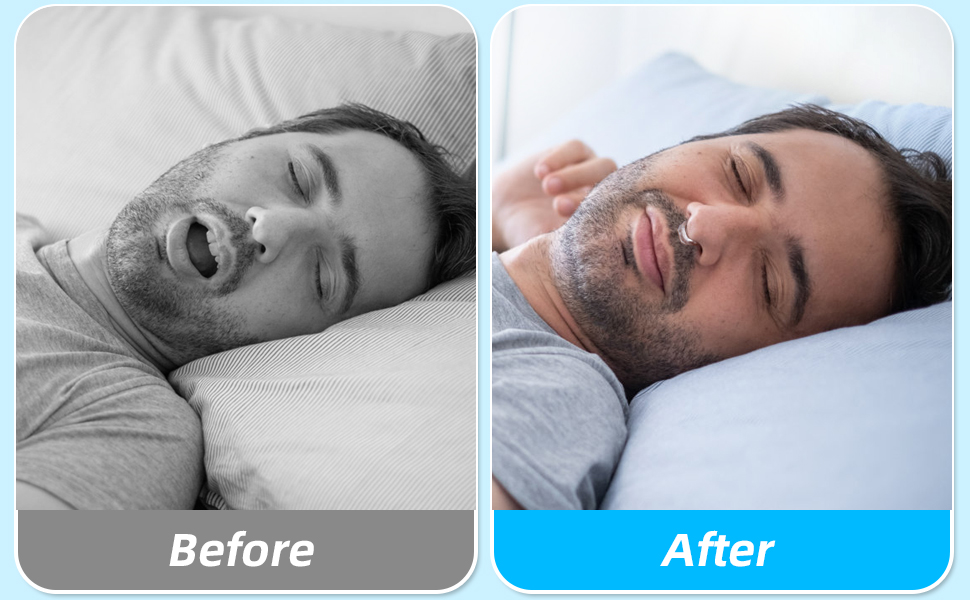 Anti Snoring Devices