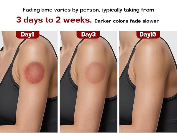 cupping