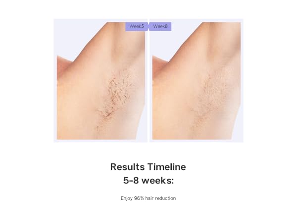 laser hair removal device