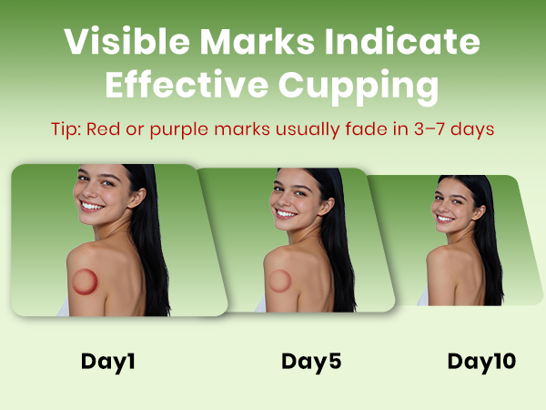 cupping set
