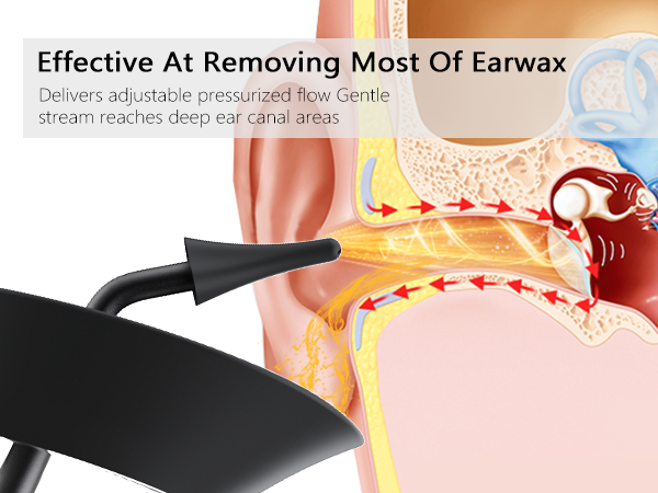 Ear Wax Removal A+4