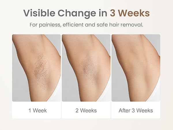 epilators hair removal for women