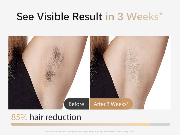home laser hair removal
