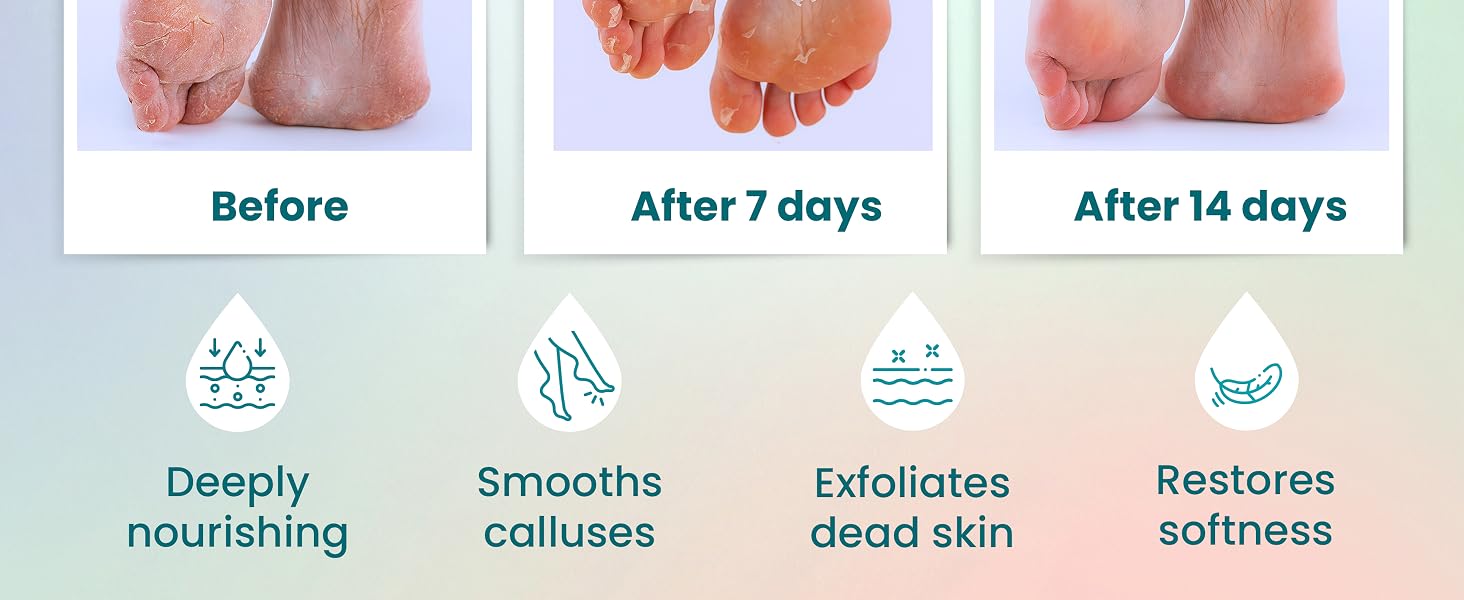 foot peel foot peel mask tca chemical peel foot mask peel foot peel mask for dry cracked feet extrem