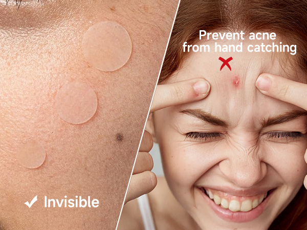 pimple patches