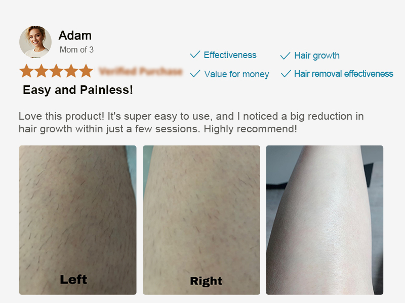 at home laser hair removal