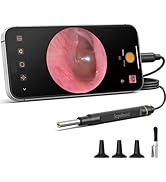 ScopeAround Otoscope Ear Camera, Ear Wax Removal Tool 1080P FHD Video Otoscope,3.9mm Earwax Remov...
