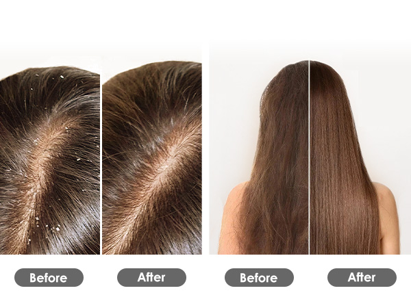 Scalp Exfoliator for Dandruff Removal