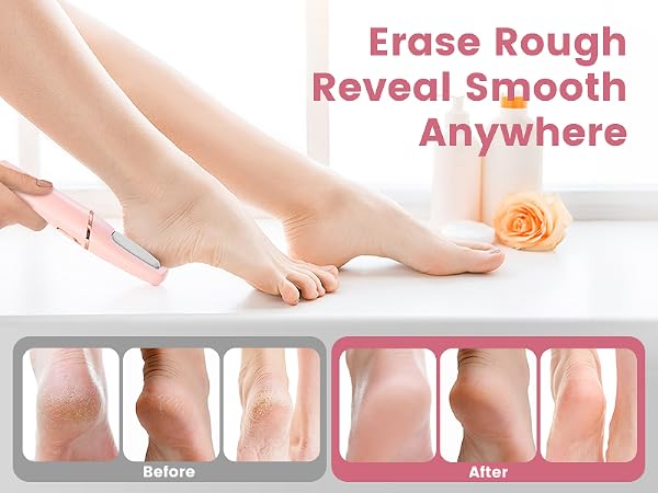 calus, remover for feet electric foot callus remover electric foot callus remover tool electric