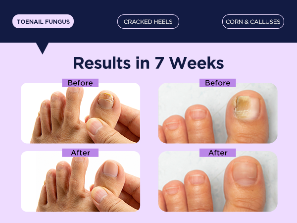 toenail Fungus