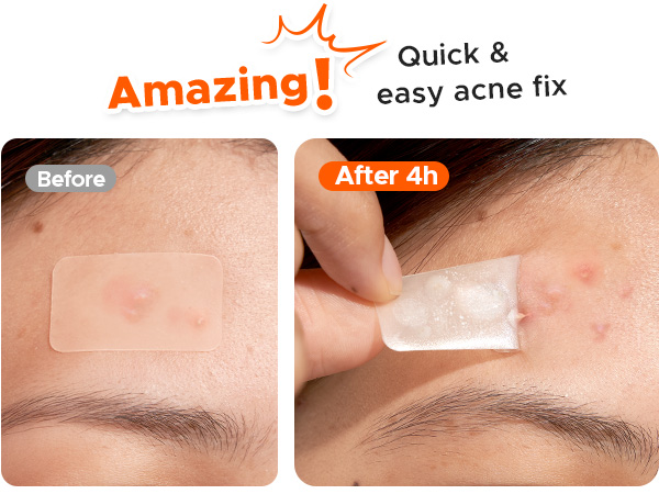 Large pimple patches