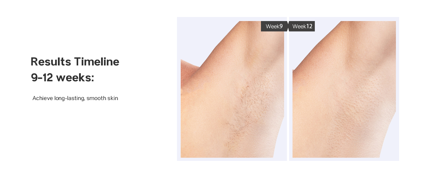 laser hair removal device