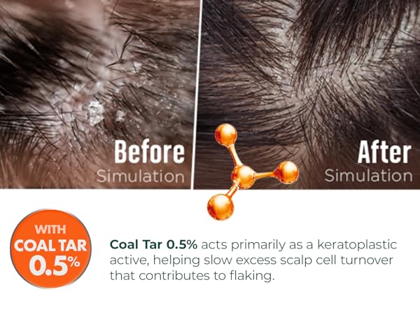 Coal tar 0.5% slows excess scalp cell turnover, before and after simulation of dandruff relief