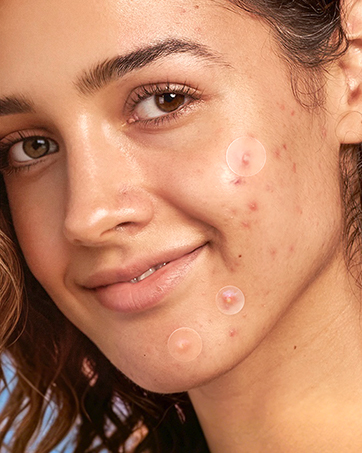 for pimple patches