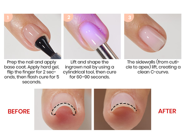 Correct Ingrown Nails