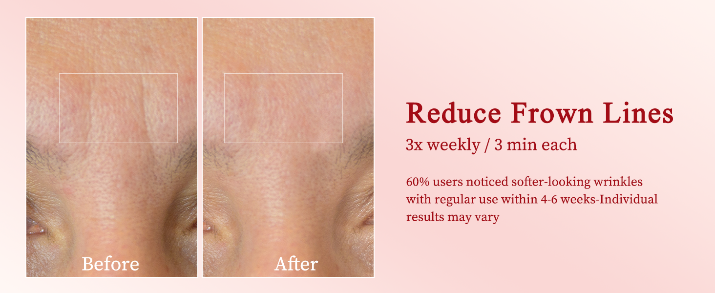 Skin Tightening Device
