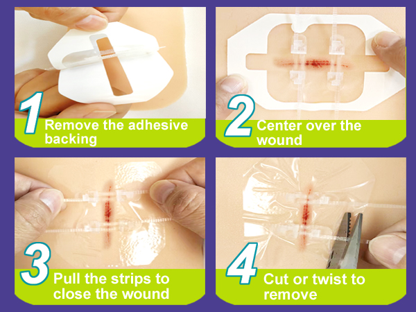40 Pack Wound Closure Strips