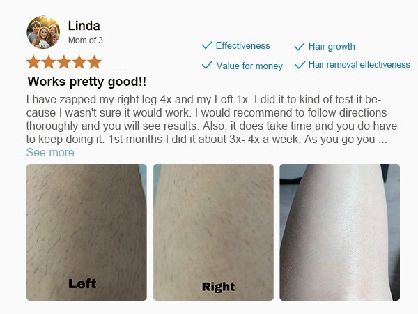 laser hair removal device