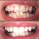 teeth whitening gels