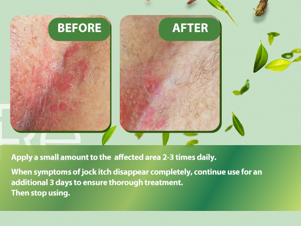 Jock Itch Cream