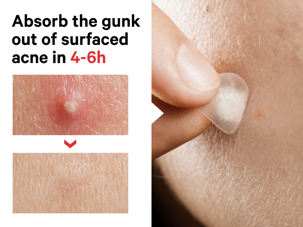 Acne spot treatment absorb the gunk in 4-6h pimple patches invisible blemish spot treatment