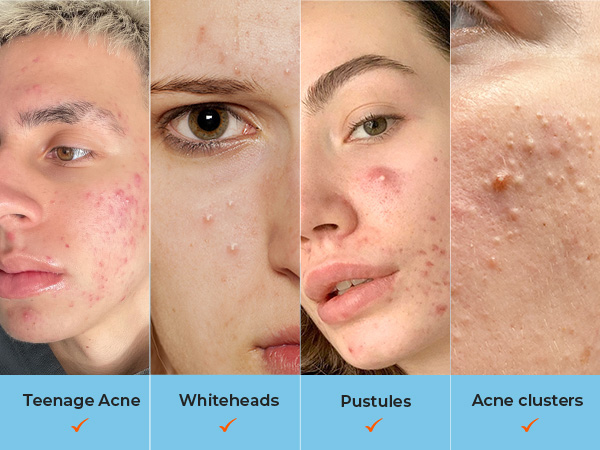 large pimple patches