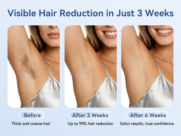Laser hair removal for women permanent