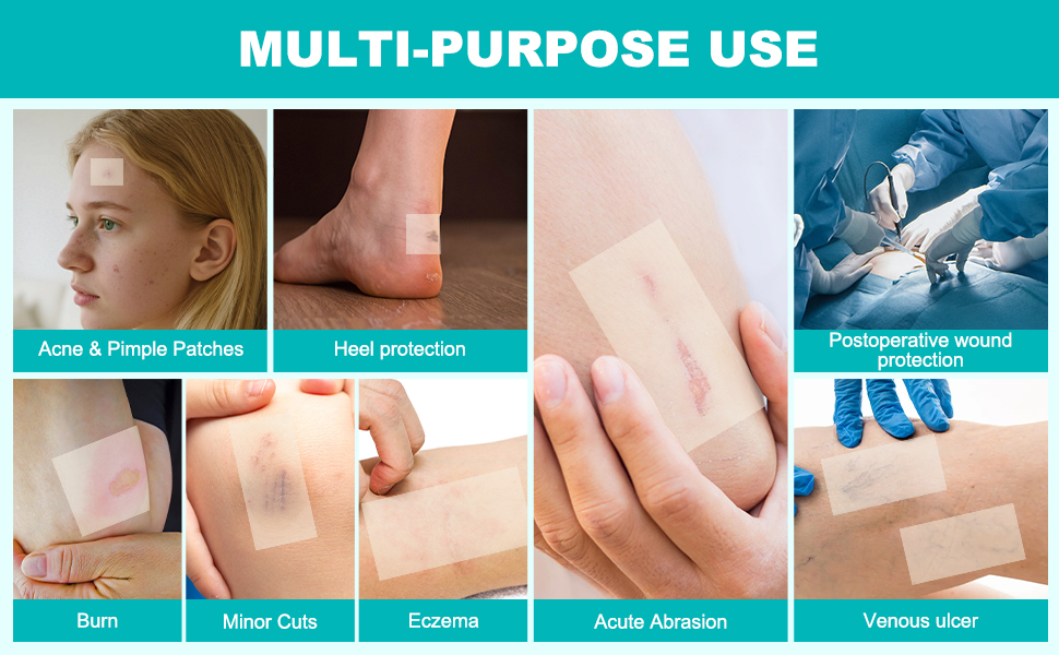 hydrocolloid bandages-hydrocolloid roll