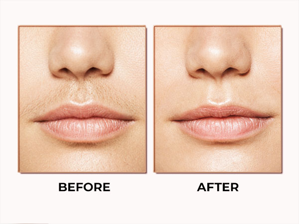 Facial Hair Removal for Women