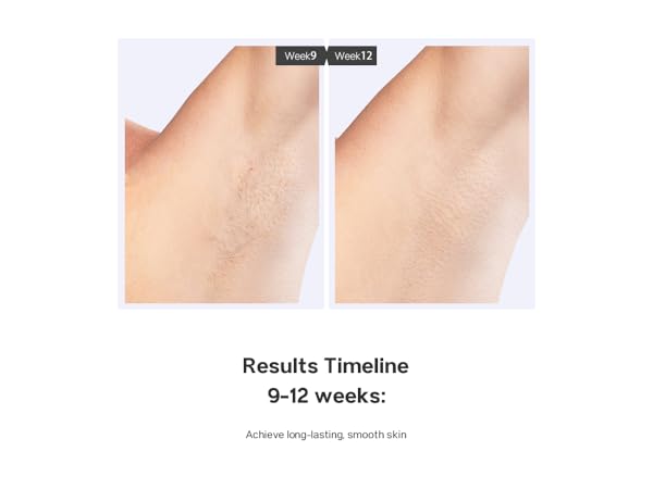 laser hair removal device