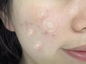 pimple patches