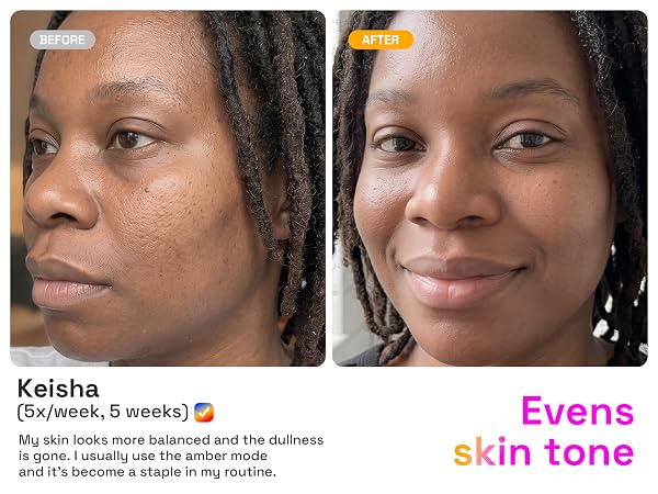 Evens skin tone