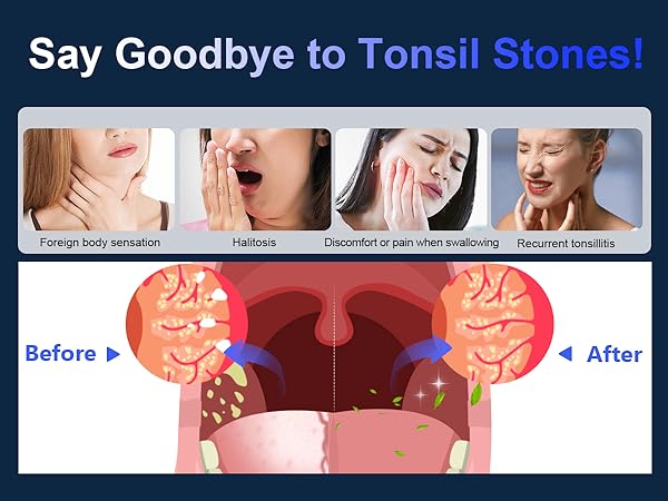 Tonsil Stone Remover Kit