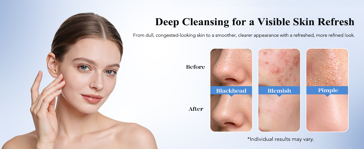 blackhead remover