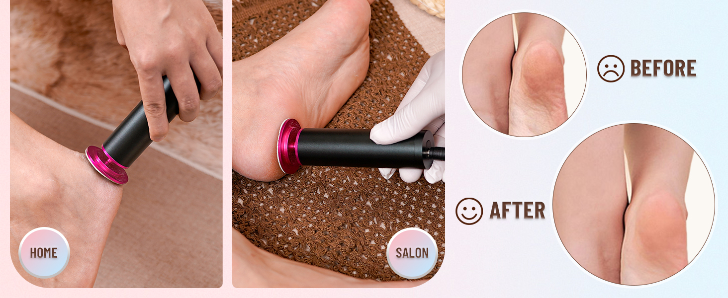 electric callus remover