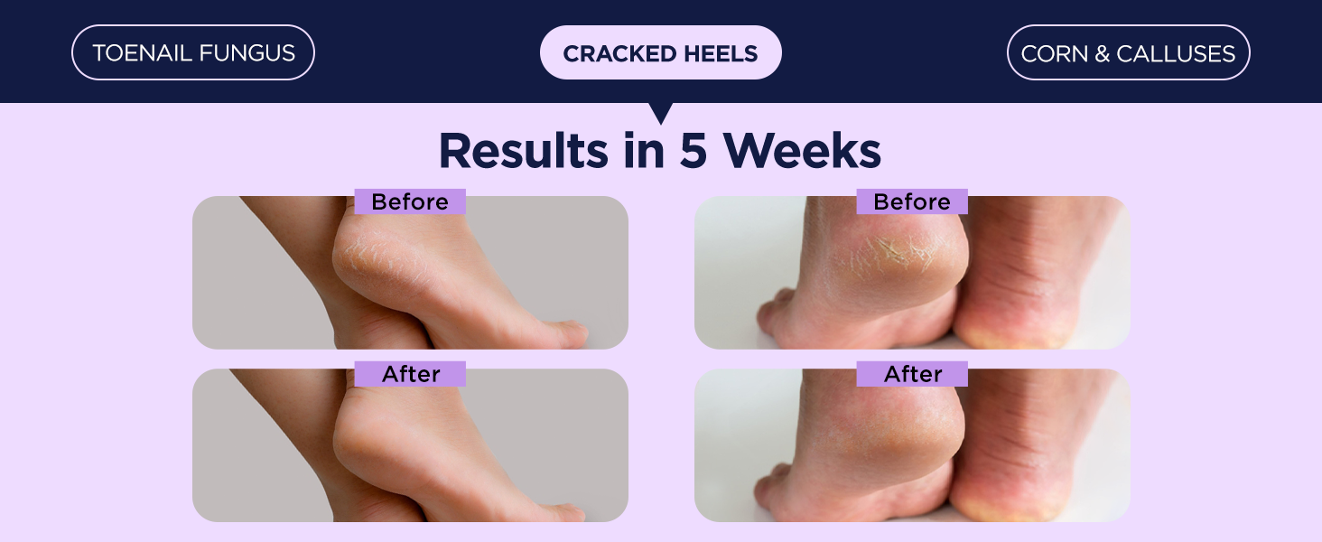 Cracked Heel