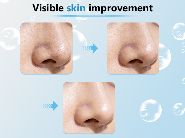 Blackhead Vacuum Remover