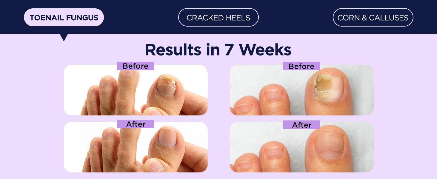 Toenail Fungus