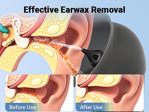 Earwax Removal