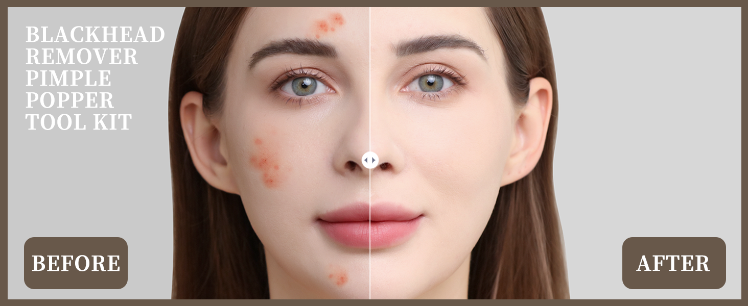 blackhead remover tool