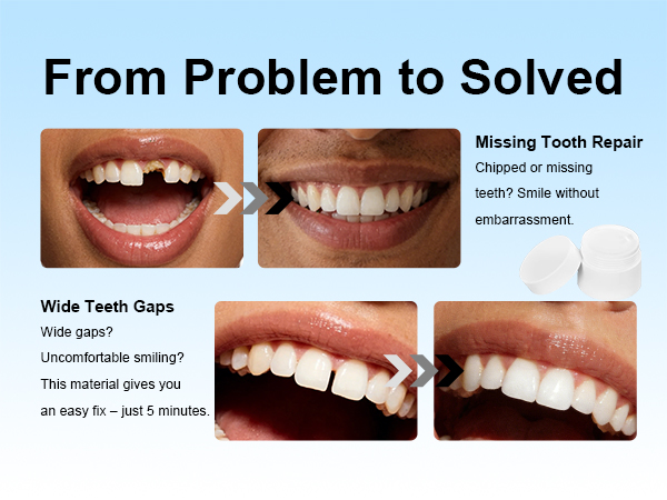 Tooth Repair Kit – Fix Missing Teeth, Wide Gaps, Chipped or Broken Teeth. Smile in 5 Minutes.