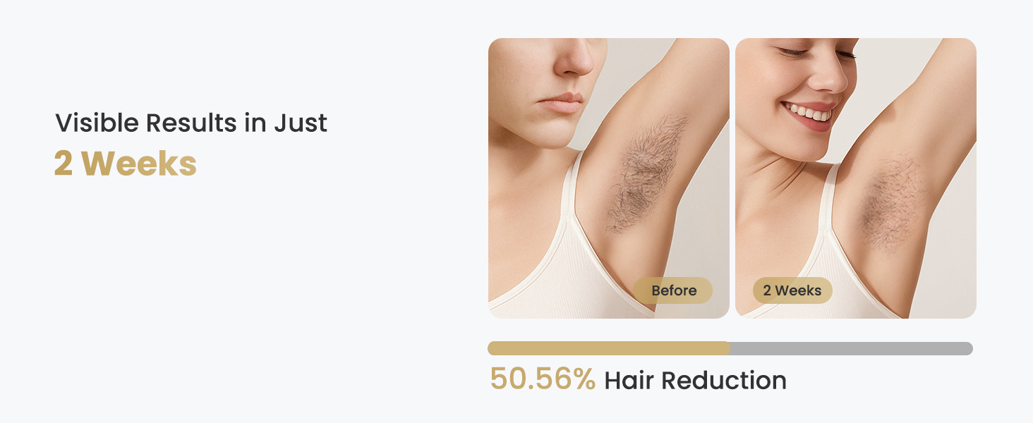 ipl laser hair removal