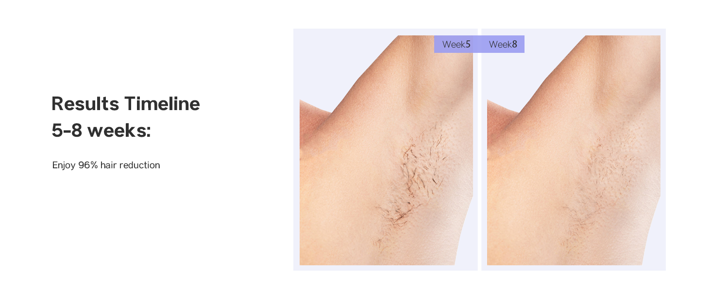 laser hair removal device