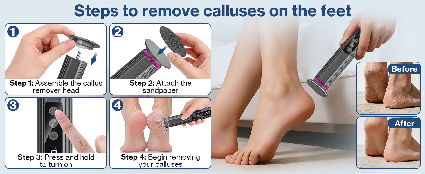 Text reads 'Steps to remove calluses on the feet' followed by a series of instructional medical or care procedure images showing steps on treating feet.