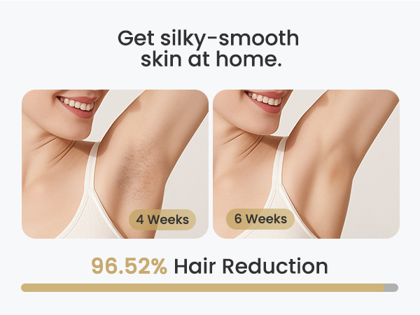 laser hair removal for women