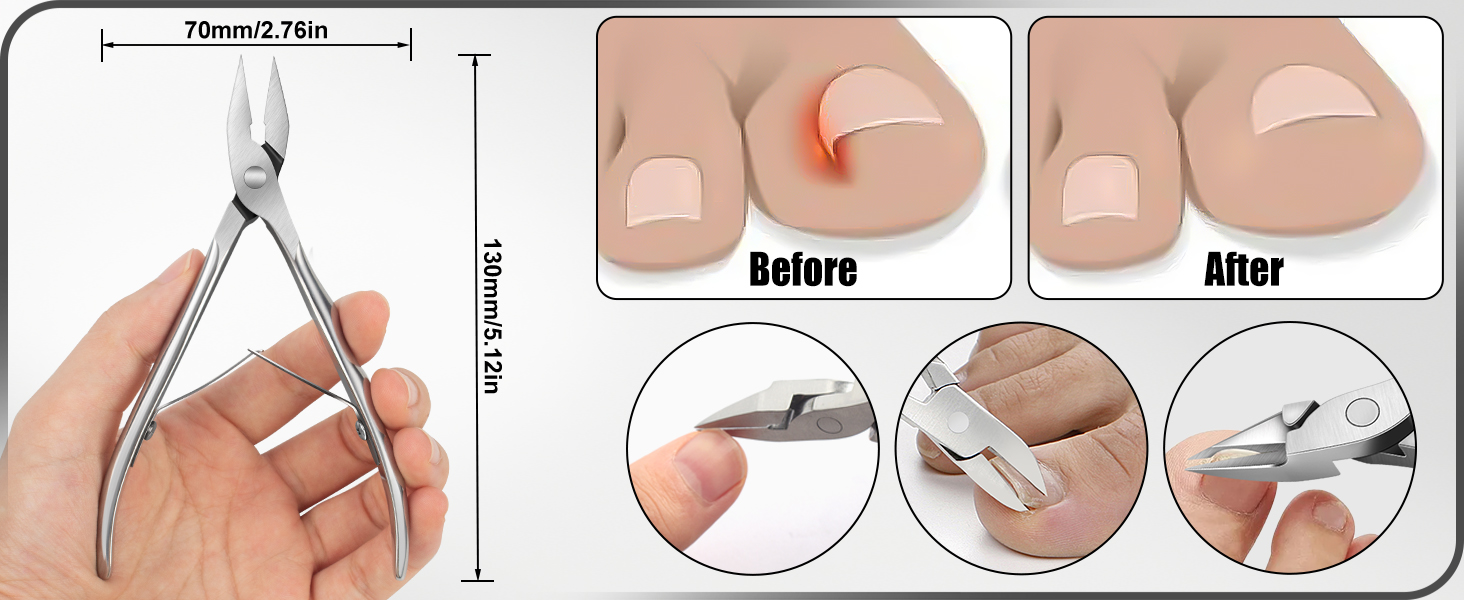 ingrown toenail treatment